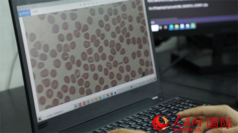 Timu ya Madaktari wa China ya Kikosi cha 25 cha walinda amani nchini DRC  yatumia Akili Bandia (AI) Kuthibitisha haraka ugonjwa wa Malaria 